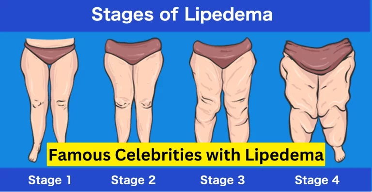 10 Famous Celebrities with Lipedema